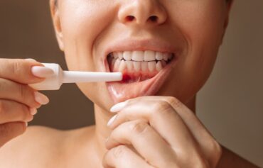 Periodontal Terapi